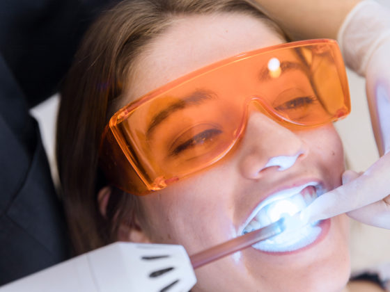 Kanata Teeth Whitening Procedure Stittsville