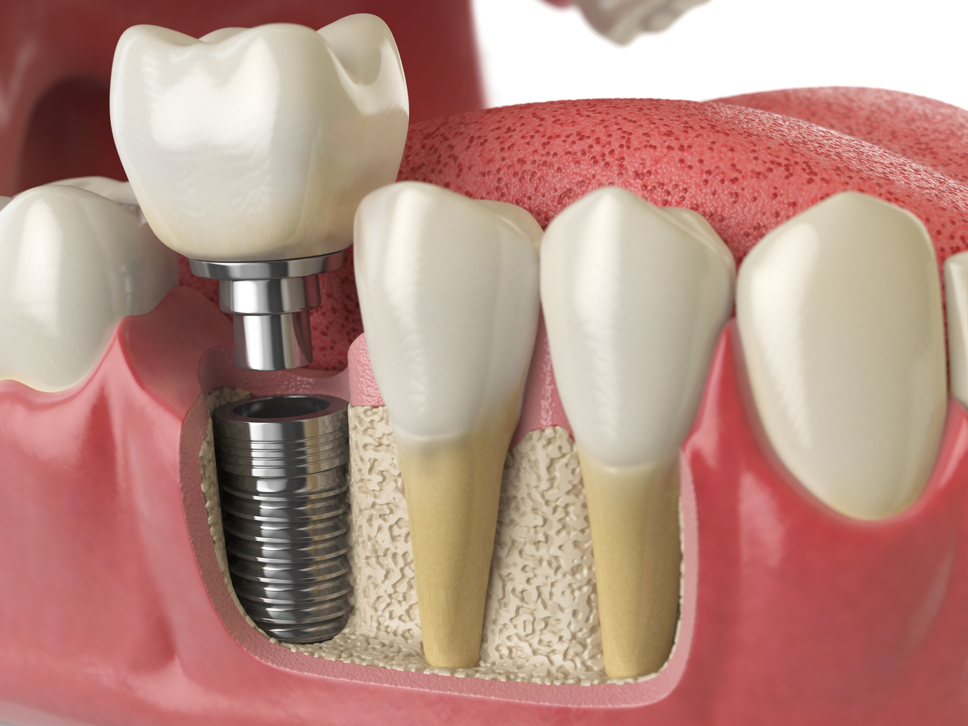 Dentists Dunrobin Dental Implants
