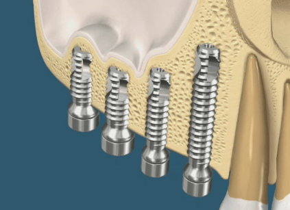 Kanata Implants Dunrobin - ELEVATION OF THE MAXILLARY SINUS