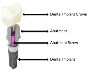 Dental Implants Kanata Crown