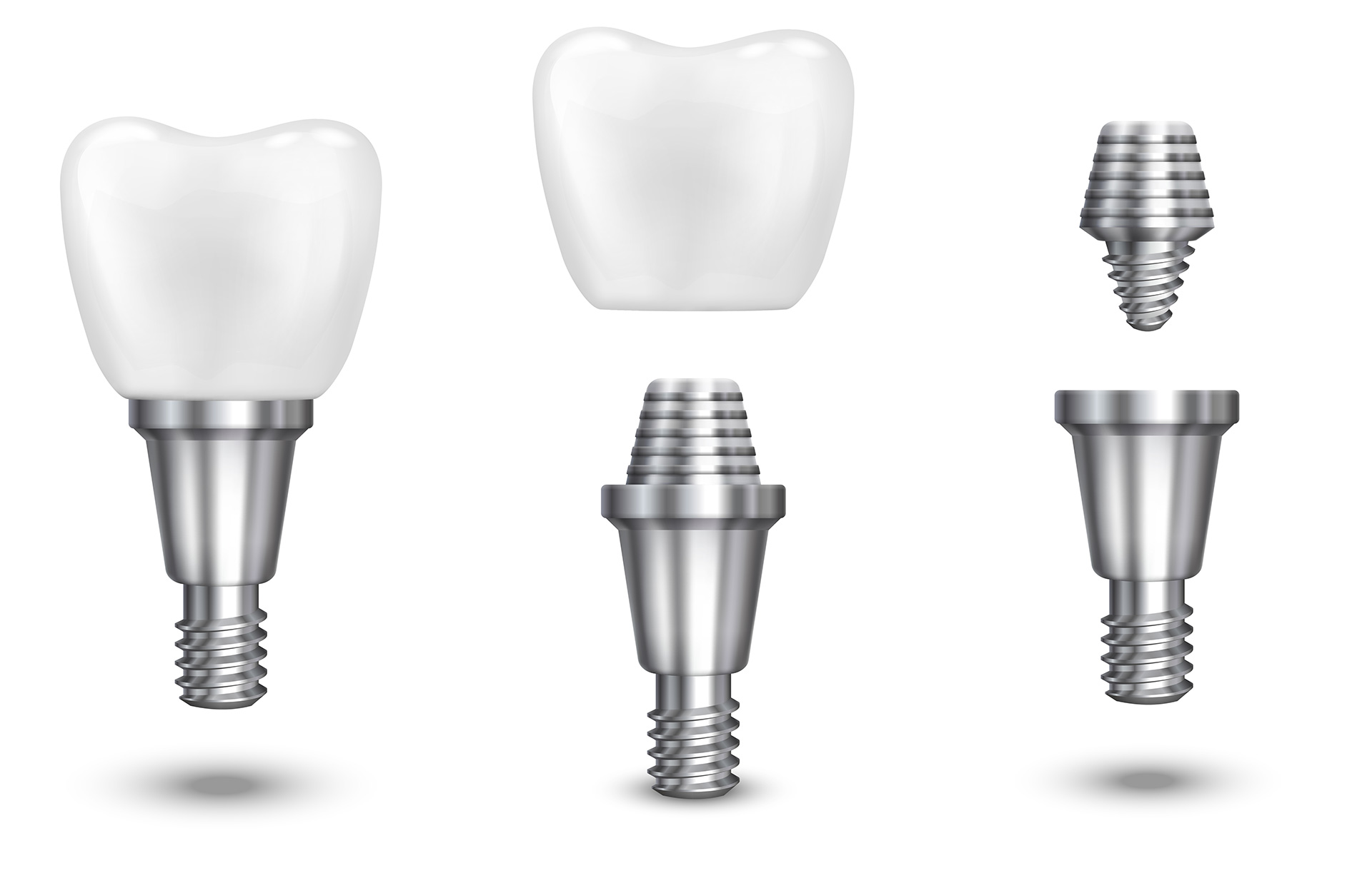 Marchwood Dental Clinic Kanata - Implants in Ottawa