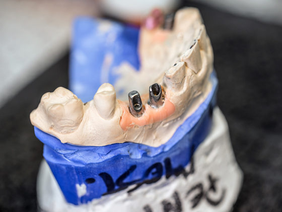 dental implant or dental bridge implant crown almonte