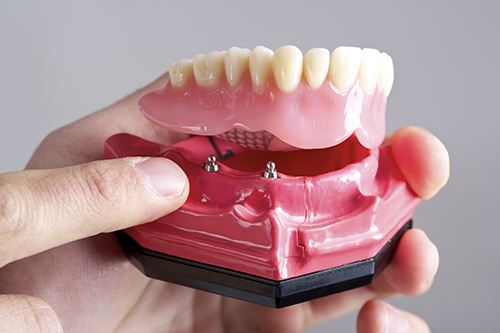 Implant-Supported Dentures Kanata