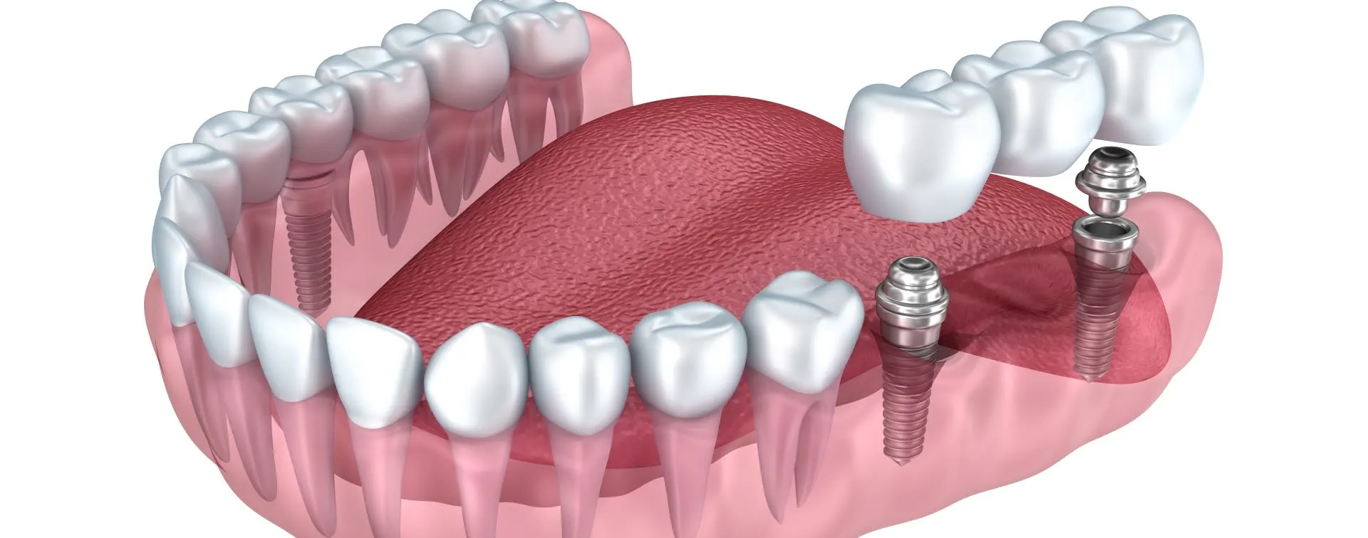 Marchwood Dental Clinic Kanata - Implants in Ottawa