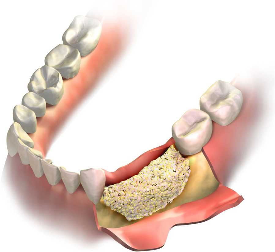 Antibacterial coating for dental implants