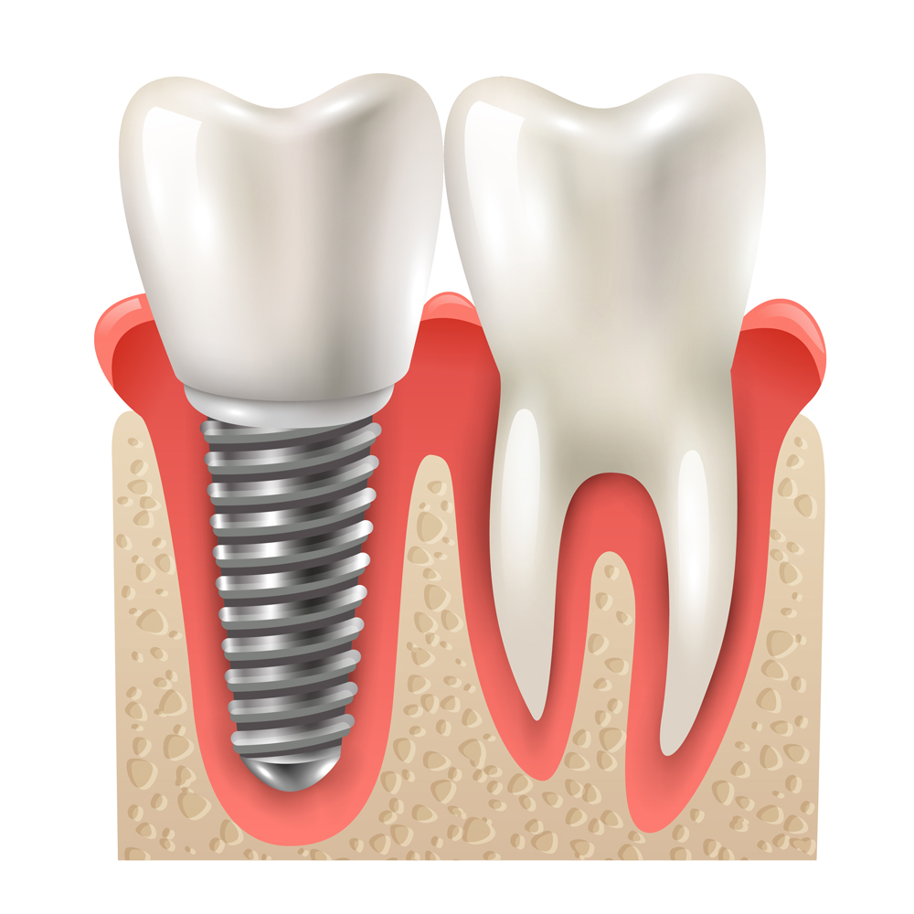 dental implants the best option for replacing teeth